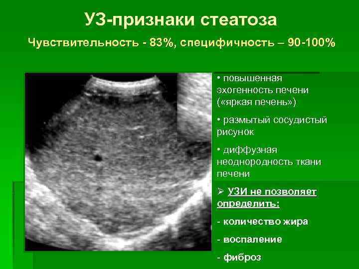 УЗ-признаки стеатоза Чувствительность - 83%, специфичность – 90 -100% • повышенная эхогенность печени (