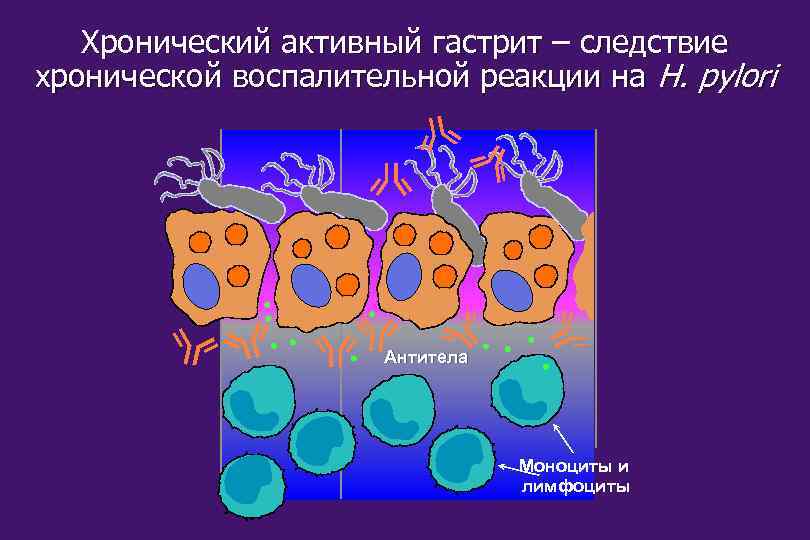 Хронический активный гастрит – следствие хронической воспалительной реакции на H. pylori Антитела Моноциты и