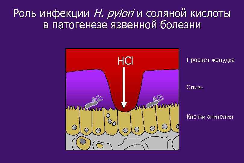 Роль инфекции H. pylori и соляной кислоты в патогенезе язвенной болезни HCl Просвет желудка
