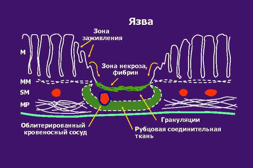 Зона заживления Язва M Зона некроза, фибрин MM SM MP Облитерированный кровеносный сосуд Грануляции