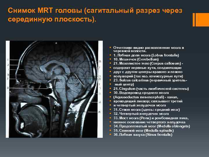 Снимок MRT головы (сагитальный разрез через серединную плоскость). § Отчетливо видно расположение мозга в