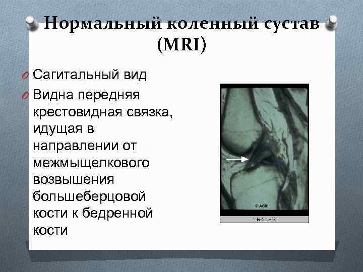 Нормальный коленный сустав (MRI) O Сагитальный вид O Видна передняя крестовидная связка, идущая в