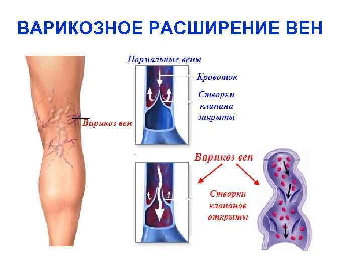 ВАРИКОЗНОЕ РАСШИРЕНИЕ ВЕН 