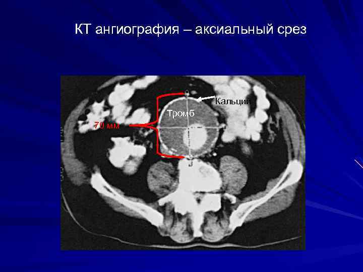 Аневризма брюшной аорты узи признаки и фото с описанием