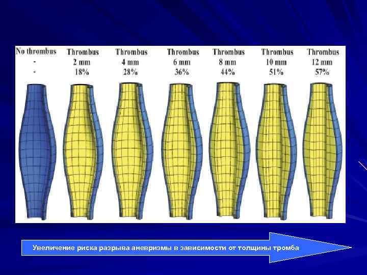 Увеличение риска разрыва аневризмы в зависимости от толщины тромба 