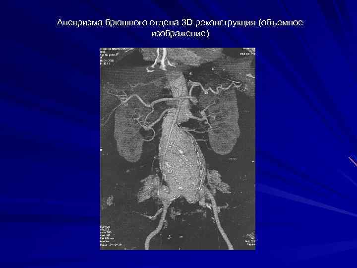 Аневризма брюшной аорты фото