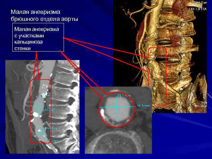 Кальцинаты в стенках аорты