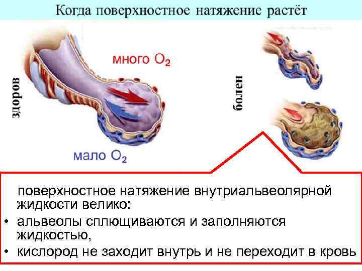 поверхностное натяжение внутриальвеолярной жидкости велико: • альвеолы сплющиваются и заполняются жидкостью, • кислород не