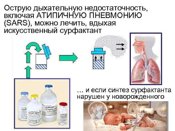 Острую дыхательную недостаточность, включая АТИПИЧНУЮ ПНЕВМОНИЮ (SARS), можно лечить, вдыхая искусственный сурфактант … и