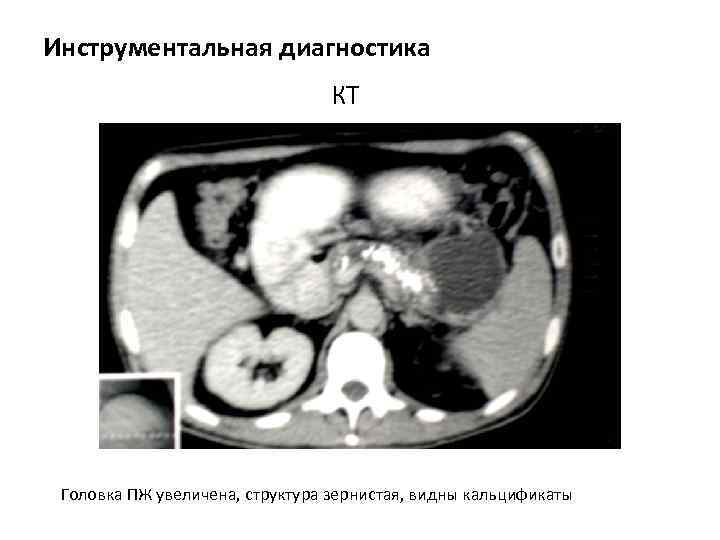 Инструментальная диагностика КТ Головка ПЖ увеличена, структура зернистая, видны кальцификаты 