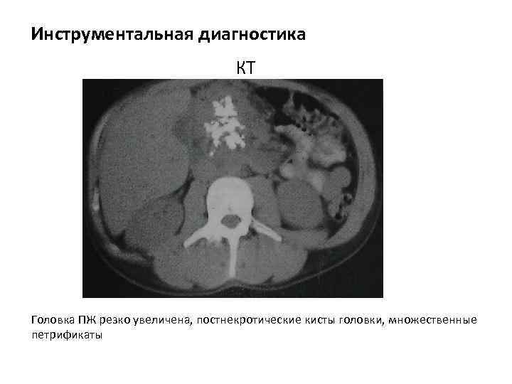 Инструментальная диагностика КТ Головка ПЖ резко увеличена, постнекротические кисты головки, множественные петрификаты 