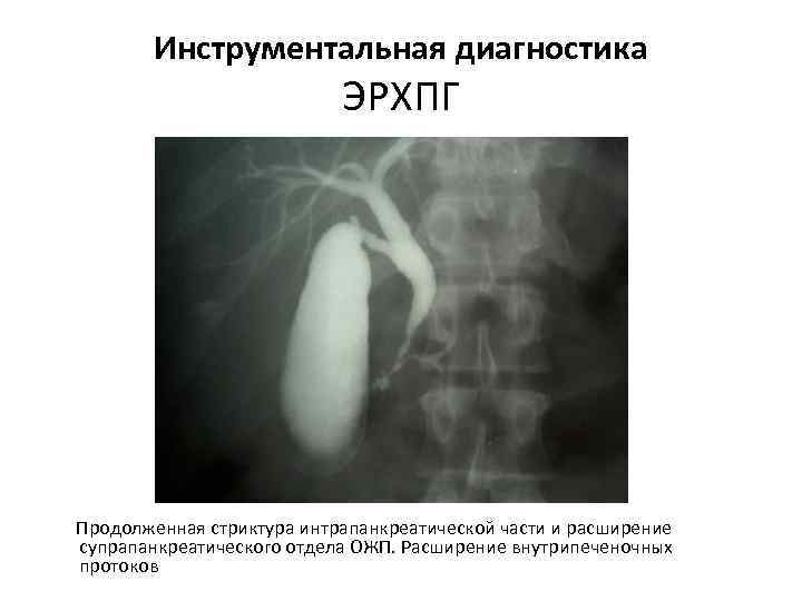 Инструментальная диагностика ЭРХПГ Продолженная стриктура интрапанкреатической части и расширение супрапанкреатического отдела ОЖП. Расширение внутрипеченочных