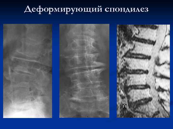 Спондилез шейного отдела позвоночника. Деформирующий спондилез l2 l5. Спондилез поясничного отдела рентген. Остеохондроз деформирующий спондилез. Остеохондроз деформирующий спондилоартроз что это.