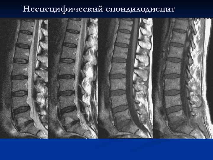 Модик 1. Анкилозирующий спондилит мрт. Спондилит спондилодисцит. Спондилит поясничного отдела кт. Асептический спондилодисцит l5-s1.