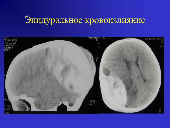 Эпидуральное кровоизлияние 