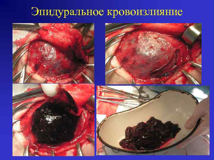 Эпидуральное кровоизлияние 