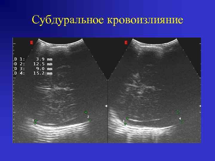 Субдуральное кровоизлияние 