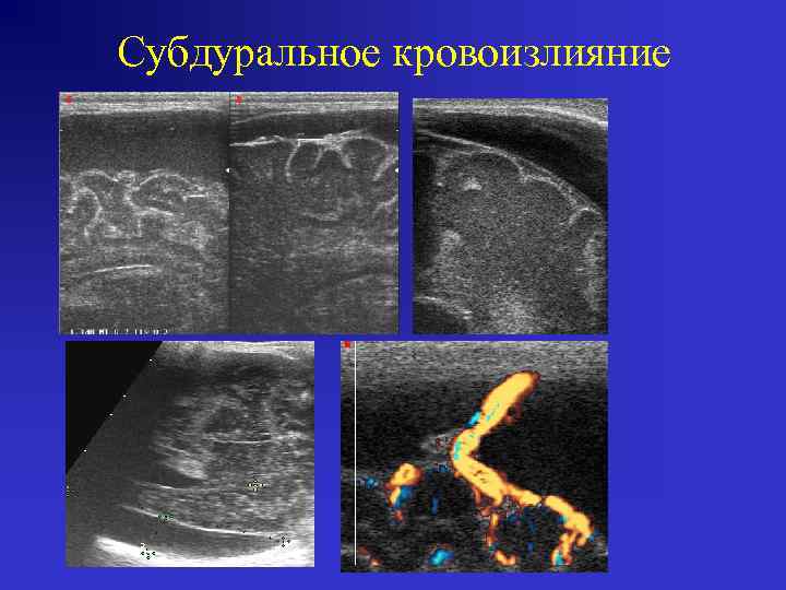 Субдуральное кровоизлияние 