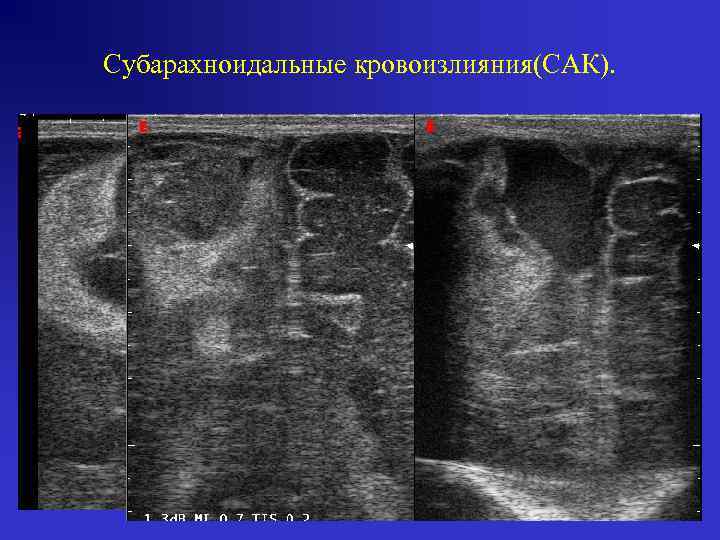 Субарахноидальные кровоизлияния(САК). 