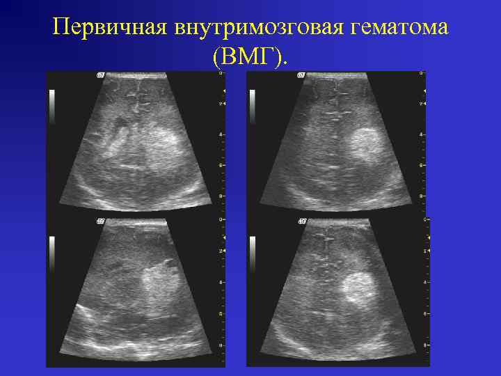 Первичная внутримозговая гематома (ВМГ). 