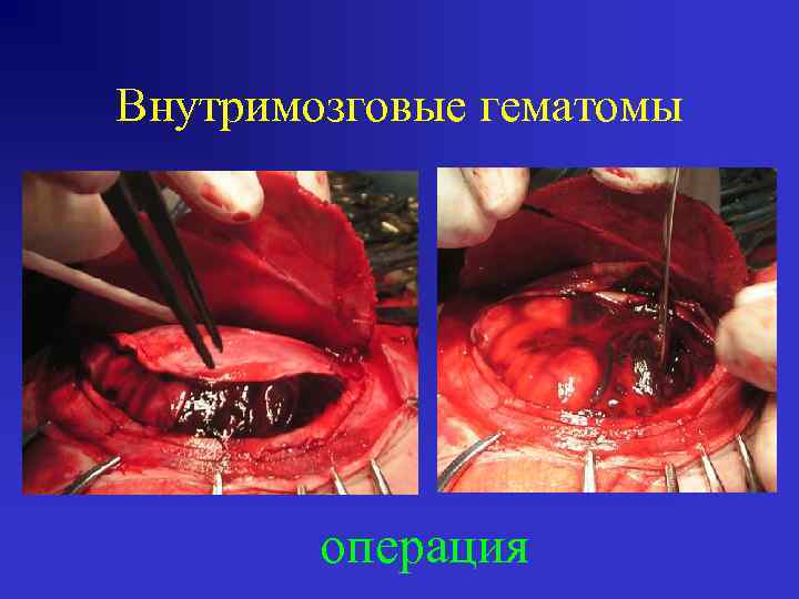 Внутримозговые гематомы операция 