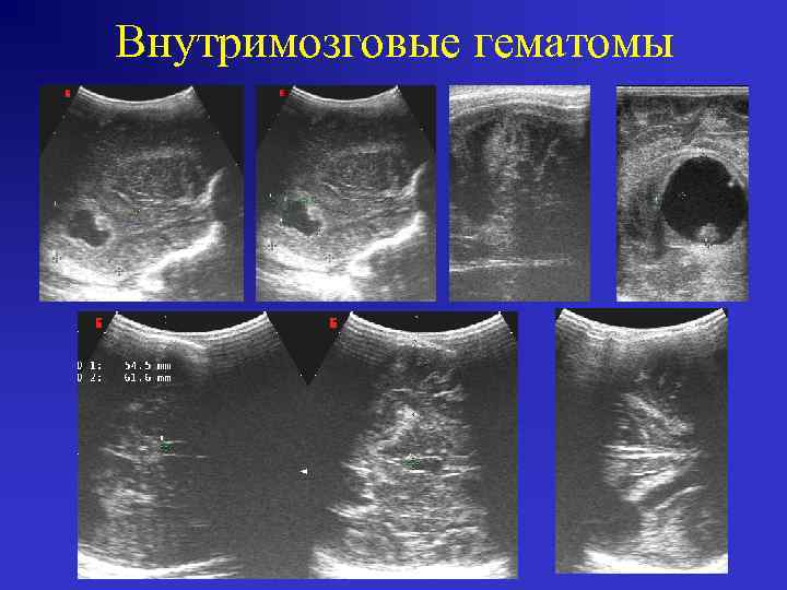 Внутримозговые гематомы 
