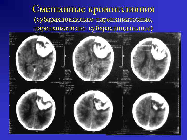 Смешанные кровоизлияния (субарахноидально-паренхиматозные, паренхиматозно- субарахноидальные) 