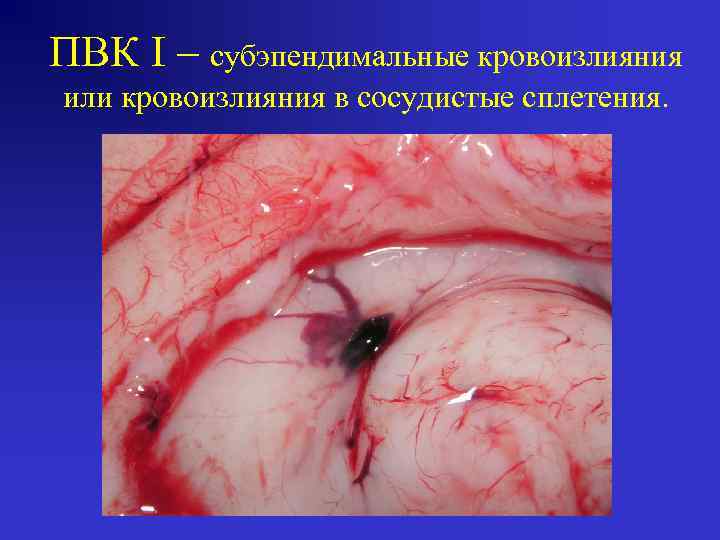 ПВК I – субэпендимальные кровоизлияния или кровоизлияния в сосудистые сплетения. 