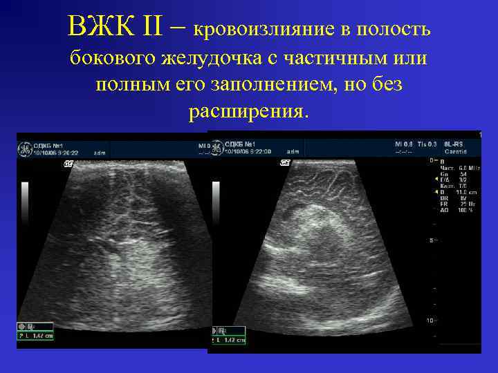 ВЖК II – кровоизлияние в полость бокового желудочка с частичным или полным его заполнением,