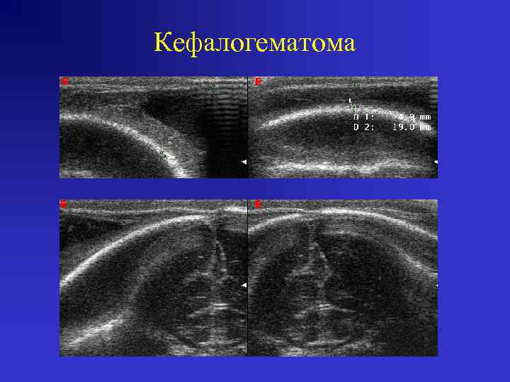 Кефалогематома 