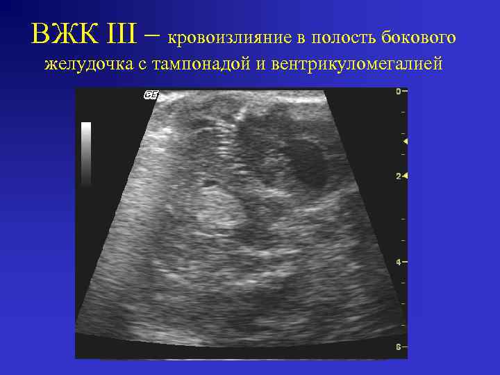 ВЖК III – кровоизлияние в полость бокового желудочка c тампонадой и вентрикуломегалией 