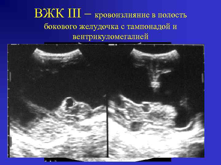 ВЖК III – кровоизлияние в полость бокового желудочка c тампонадой и вентрикуломегалией 