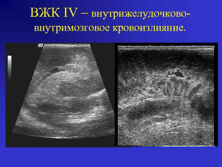 ВЖК IV – внутрижелудочкововнутримозговое кровоизлияние. 