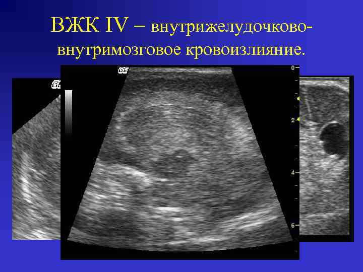 ВЖК IV – внутрижелудочкововнутримозговое кровоизлияние. 