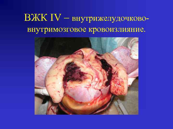 ВЖК IV – внутрижелудочкововнутримозговое кровоизлияние. 