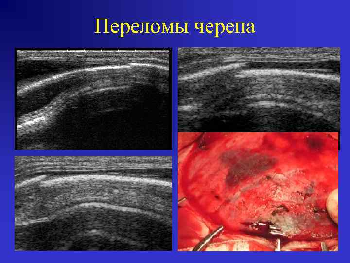 Переломы черепа 