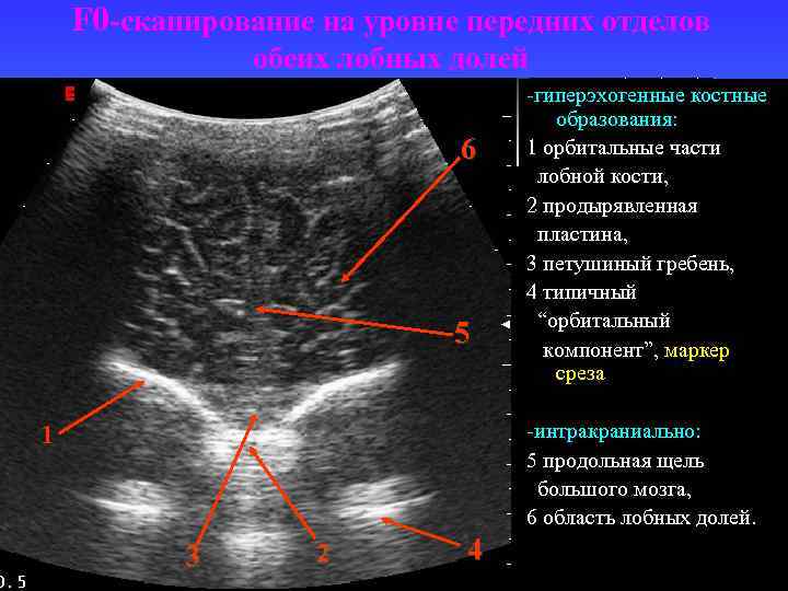 Гиперэхогенный фокус. Гиперэхогенные включения в печени на УЗИ. Гиперэхогенные структуры на УЗИ. Гиперэхогенные структуры на УЗИ печени. Гиперэхогенный очаг в мочевом пузыре.