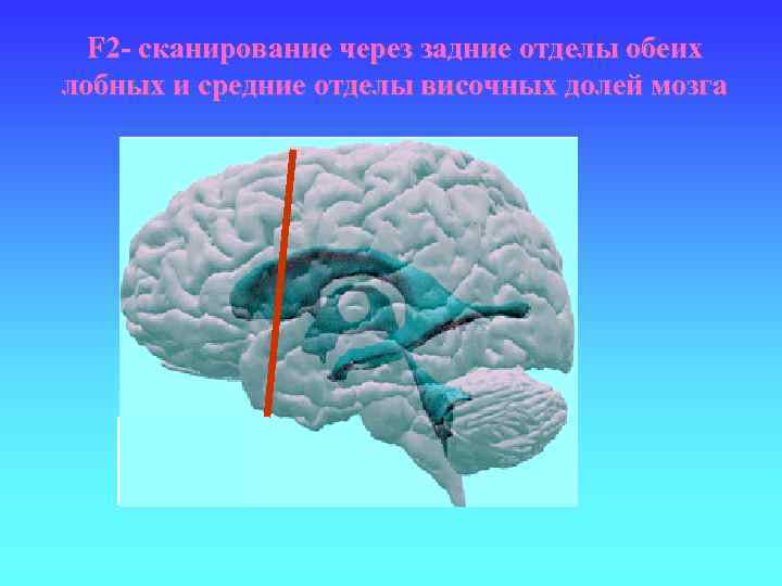 F 2 - сканирование через задние отделы обеих лобных и средние отделы височных долей