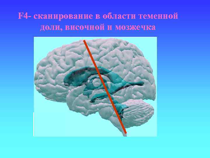 F 4 - сканирование в области теменной доли, височной и мозжечка 