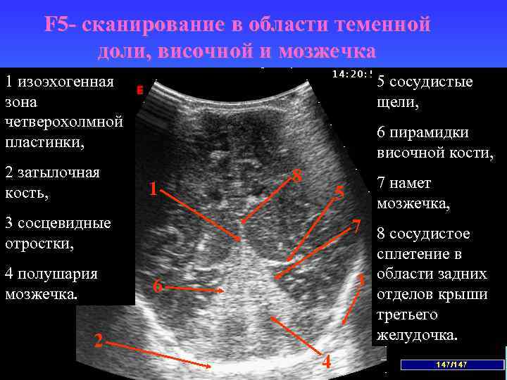 F 5 - сканирование в области теменной доли, височной и мозжечка 1 изоэхогенная зона