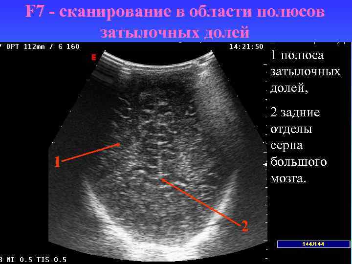 F 7 - сканирование в области полюсов затылочных долей 1 полюса затылочных долей, 2