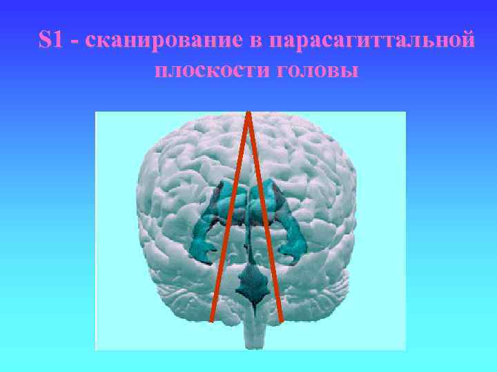 S 1 - сканирование в парасагиттальной плоскости головы 