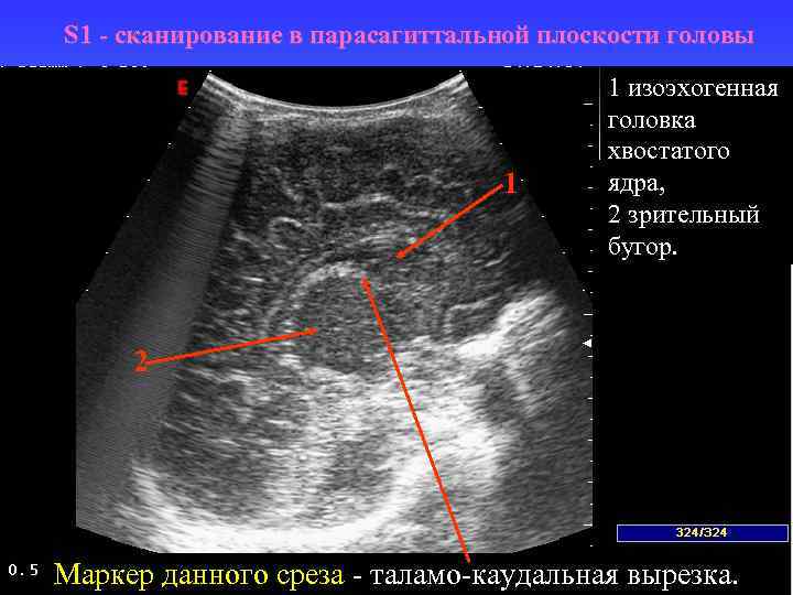 Каудоталамическая вырезка. УЗИ головного мозга нейросонография. Нейросонография плоскости сканирования. Каудоталамическая вырезка на УЗИ.