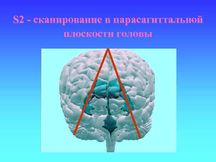 S 2 - сканирование в парасагиттальной плоскости головы 