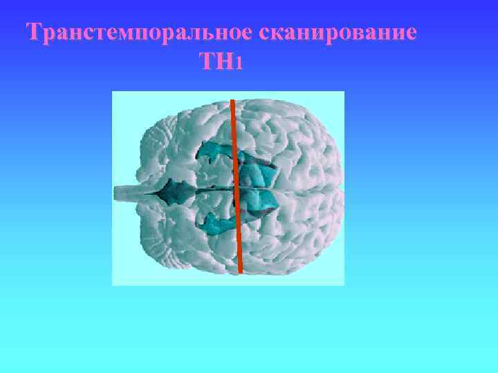 Транстемпоральное сканирование TH 1 