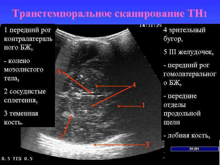 Транстемпоральное сканирование TH 1 1 передний рог контралатераль ного БЖ, - колено мозолистого тела,