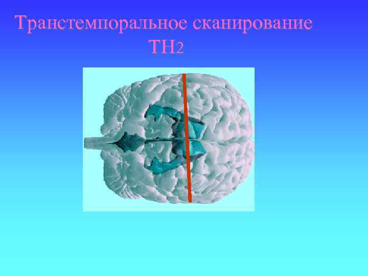 Транстемпоральное сканирование TH 2 