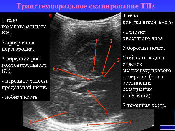Транстемпоральное сканирование TH 2 4 тело контралатерального 1 тело гомолатерального БЖ, 2 прозрачная перегородка,