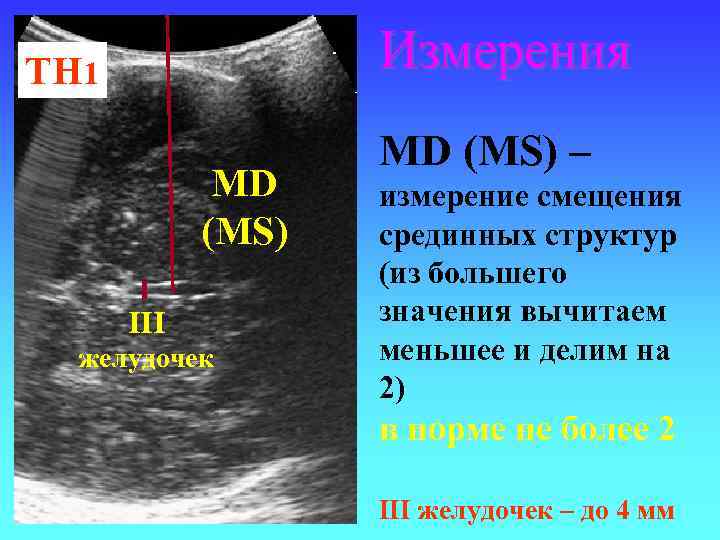 Измерения ТН 1 MD (MS) III желудочек MD (MS) – измерение смещения срединных структур