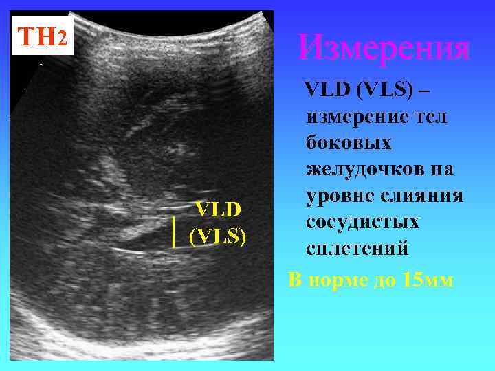 ТН 2 Измерения VLD (VLS) – измерение тел боковых желудочков на уровне слияния сосудистых